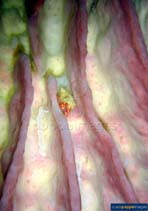 Image of Dardanus gemmatus (Jeweled anemone hermit)